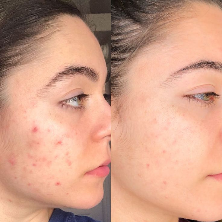 Complete skincare routine recommendation korean skincare glass skin dry skin acne prone skin